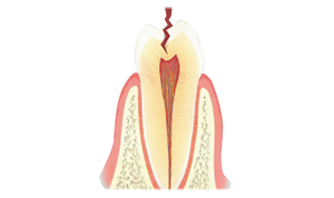 歯に亀裂が入っているイラスト